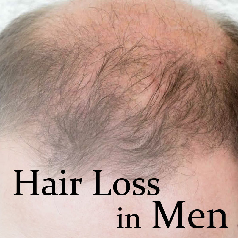 Hair Loss In Men - DR SIN YONG